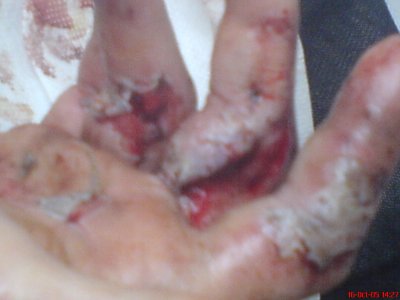 Mangled hand.JPG